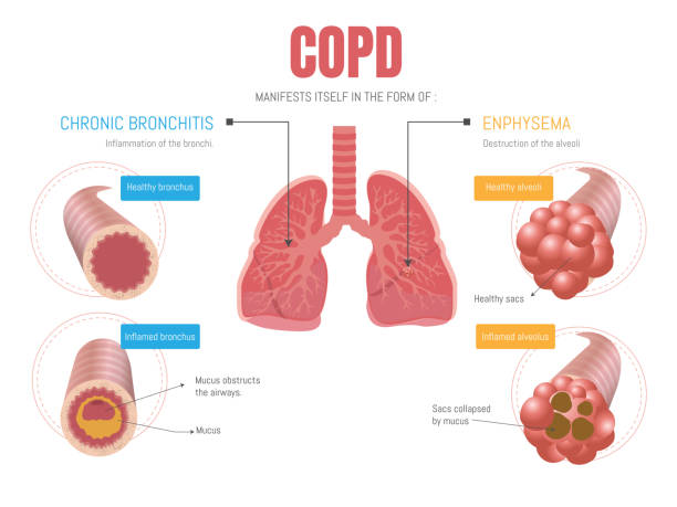 Best Doctors For Copd Treatment in Ghodbunder Road,Thane
